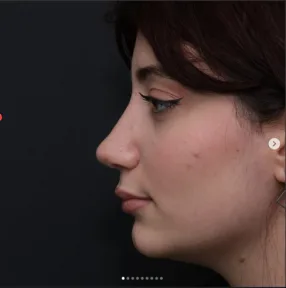 Rhinoplasty