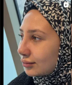 Rhinoplasty