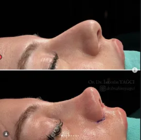Rhinoplasty