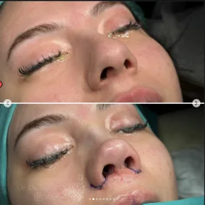 Rhinoplasty