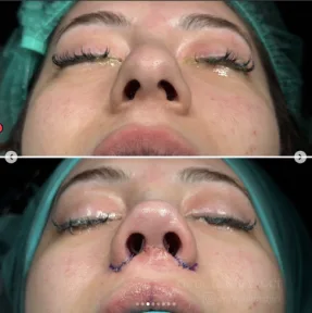 Rhinoplasty