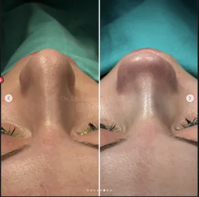 Rhinoplasty